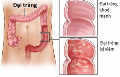 Nấm lim xanh- liệu pháp hỗ trợ điều trị ung thư đại tràng hiệu quả