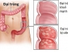 Nấm lim xanh- liệu pháp hỗ trợ điều trị ung thư đại tràng hiệu quả