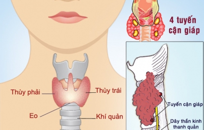 Phát hiện và điều trị sớm ung thư tuyến giáp bằng nấm lim xanh