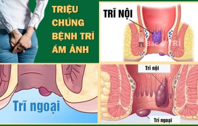 4 BÀI THUỐC ĐÔNG Y CHỮA BỆNH TRĨ HIỆU QUẢ NHẤT