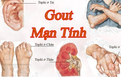 Nấm lim xanh chữa bệnh gout