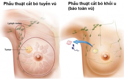 Ung thư vú có thể được chữa khỏi nhờ nấm lim xanh