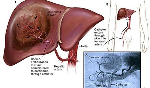 Chữa bệnh ung thư gan giai đoạn cuối