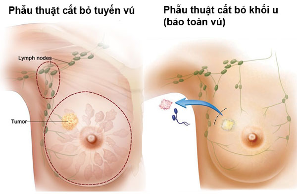 ung-thu-vu-co-the-duoc-chua-khoi-nho-nam-lim-xanh