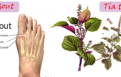 3 bài thuốc nam chữa bệnh gout tại nhà từ dân gian 3 bài thuốc nam chữa bệnh gout tại nhà từ dân gian